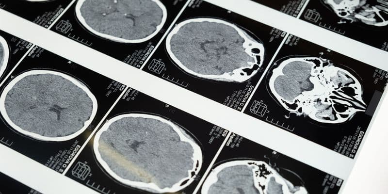 Investigadores de Ámsterdam frenan una enfermedad cerebral mortal infantil