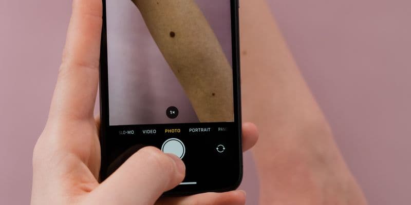 Las apps para detectar melanomas ganan popularidad en Países Bajos